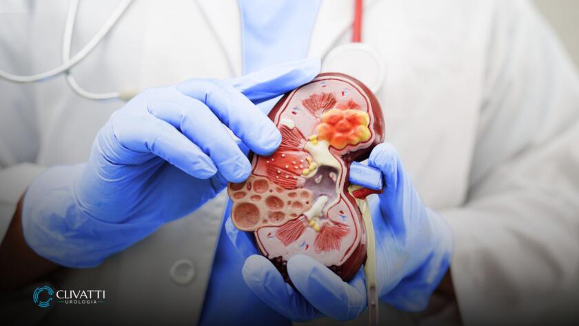 O que é um Cisto Renal? Imagem ilustra um artigo da Clínica Clivatti de Urologia.